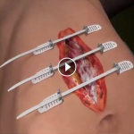 Infirmières : les sutures du future ! Qu’en pensez-vous ?